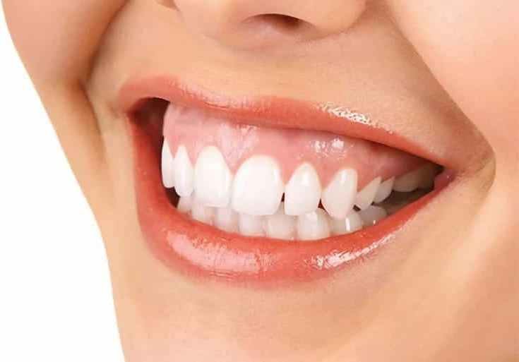 Sonrisa gingival