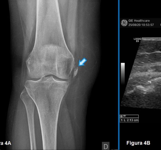Ecografía Articular